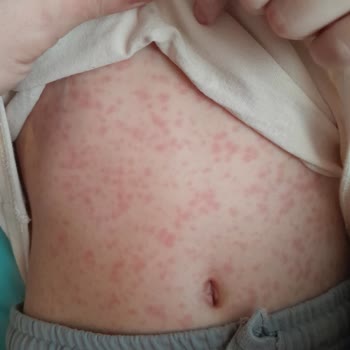 Sanovel İlaç Macrol Şurup Yan Etki!