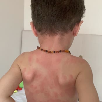 Türk Eczacılar Birliği Amoklavin Ve Macrol Antibiyotik Alerji Yaptı!