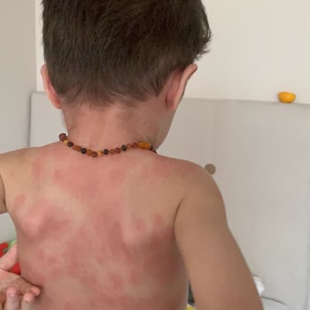 Türk Eczacılar Birliği Amoklavin Ve Macrol Antibiyotik Alerji Yaptı!