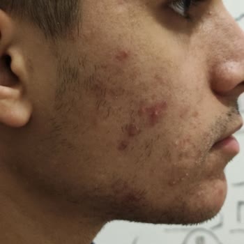 The Purest Solutions Cilt Bakım Ürününden Kaynaklanan Tahriş Problemi