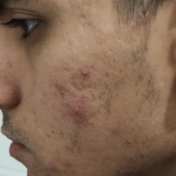 The Purest Solutions Cilt Bakım Ürününden Kaynaklanan Tahriş Problemi