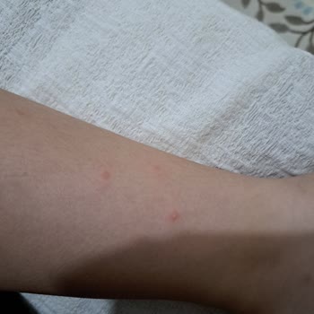 Kiperin Collagen Kullanılan Ürünün Beklenmedik Cilt Reaksiyonları