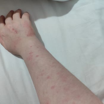 Kiperin Collagen Kullanılan Ürünün Beklenmedik Cilt Reaksiyonları