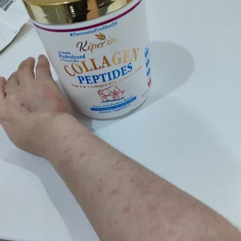 Kiperin Collagen Kullanılan Ürünün Beklenmedik Cilt Reaksiyonları