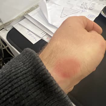 Apranax Ford İlacın Kızarıklık Yan Etkisi