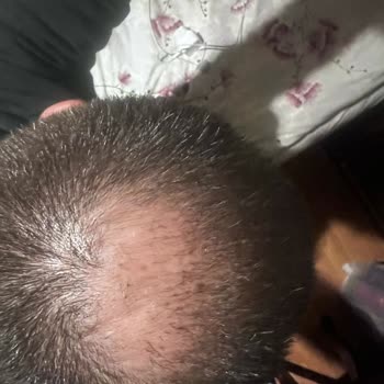 Mc Hair Center Çok Amatör İşçilik Bile Diyemiyorum. Amatörün Bile Altı