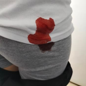 Doruk Bursa Hastanesi (Çekirge) Tonsilit Tedavisinde Yaşanan Hemşire Sorunu