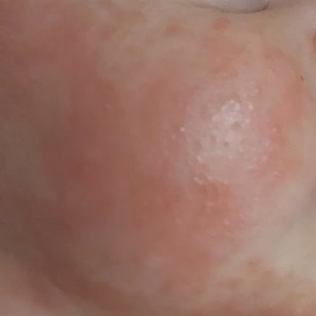 Mustela Lipid Replenishing Cream Gave My Baby An Allergy