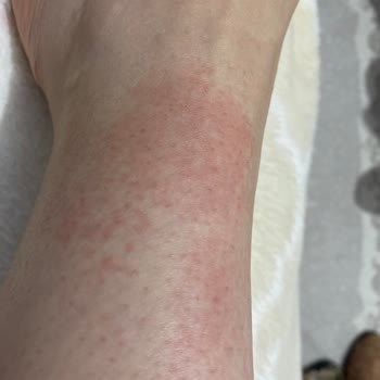 Veet Tüy Dökücü Krem Yüzünden Kolum Yandı