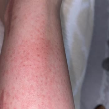 Veet Tüy Dökücü Krem Yüzünden Kolum Yandı