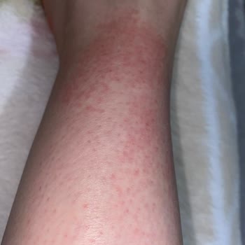 Veet Tüy Dökücü Krem Yüzünden Kolum Yandı