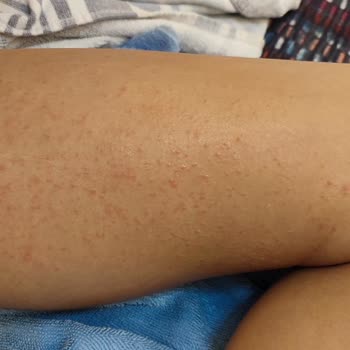 Argivit Focus Alerji Yaptı