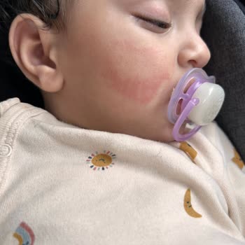 Sebamed Baby Nemlendirici Yan Etki