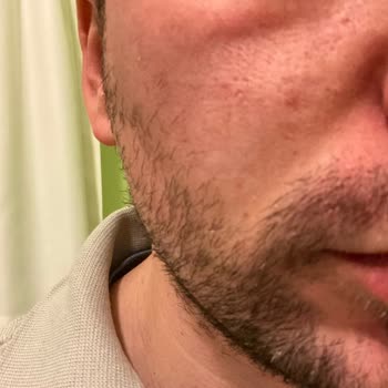 Claderm Kil Maskesi Kızarıklık