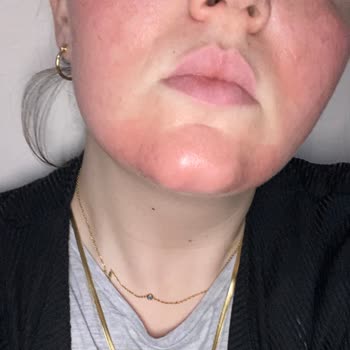 Estate Cosmetics Cilt Hassasiyetine Yol Açan Maske Sorunu