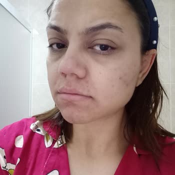 Nivea Luminous Krem: Beklenen Etki Yerine Sivilce Sorunu