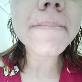 Nivea Luminous Krem: Beklenen Etki Yerine Sivilce Sorunu