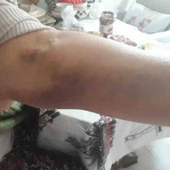 Şişli Hamidiye Etfal Eğitim Ve Araştırma Hastanesi Kan Alma Sonucu Kolumda Oluşan Morarma