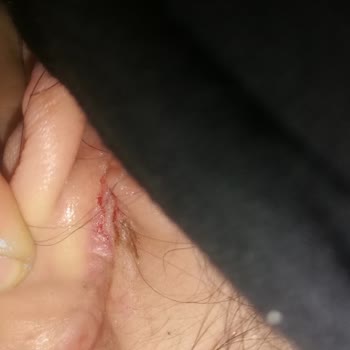 Sağlık Bakanlığı Şakak Germe Ameliyatları Ve Sonrasında Yaşanan Sorunlar