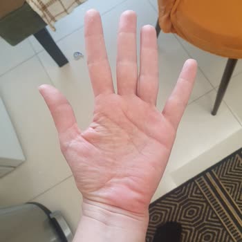 Suda Collagen Kızarıklık Ve Alerji Yapıyor Dikkat!