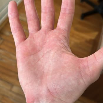 Suda Collagen Kızarıklık Ve Alerji Yapıyor Dikkat!