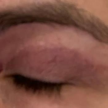 Prof. Dr. Furkan Karabekmez Göz Kapağı Ameliyatı Sonrası Beklenen Sonuç Alınamadı