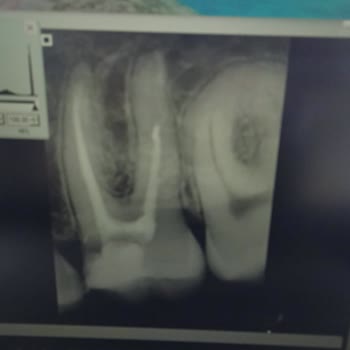 Dentsun Ağız ve Diş Sağlığı Polikliniği Kanal Tedavim Yarım Kaldı!