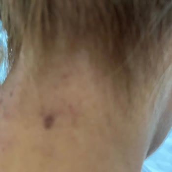 Bee Beauty Oksidan Alerji Şikayeti