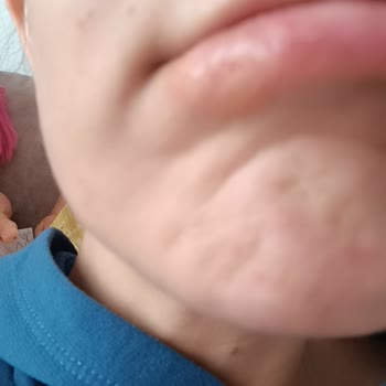 Cream Co. Serum Alerji Yaptı