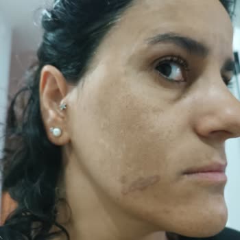 Elmas Güzellik Salonu Elmas Poliklinik Ümitköy Şubesi Leke Tedavisinde Başarısız