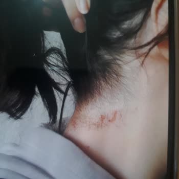 Seher Başaran Estetik & Güzellik Güzellik Merkezinde Yaşanan Lazer Epilasyon Sorunları