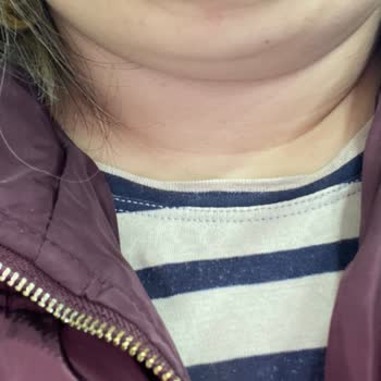 Dilan Polat Estetik Gıdı Lipo Pişmanlığı!