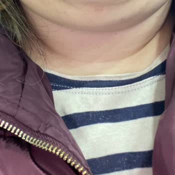 Dilan Polat Estetik Gıdı Lipo Pişmanlığı!