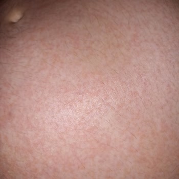 Dalin Bebek Yağı Alerji