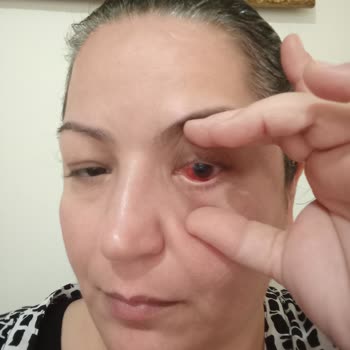 İstanbul Avcılar Murat Kölük Devlet Hastanesi Katarakt Ameliyatı Sonrası Mağduriyetim