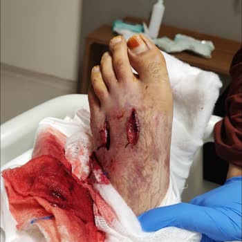 Beylikdüzü Devlet Hastanesinin Yanlış Teşhisi Ayağın Kesilmesi