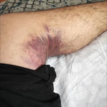 Beylikdüzü Devlet Hastanesinin Yanlış Teşhisi Ayağın Kesilmesi