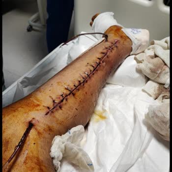 Beylikdüzü Devlet Hastanesinin Yanlış Teşhisi Ayağın Kesilmesi