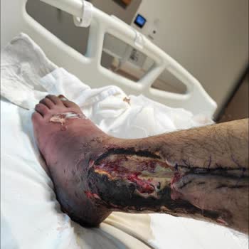 Esenyurt Necmi Kadıoğlu Devlet Hastanesi Esenyurt Devlet Hastanesinin Yanlış Teşhis Sonucu Ayağımın Kesilmesi