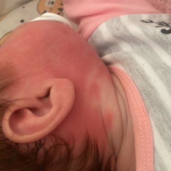 Mustela Vücut Losyonu İnanılır Gibi Değil Bebeğimin Yüzü Yandı