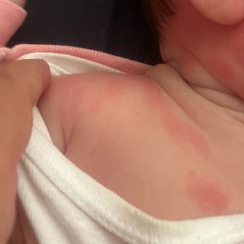 Mustela Vücut Losyonu İnanılır Gibi Değil Bebeğimin Yüzü Yandı