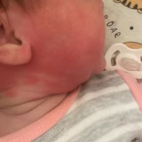 Mustela Vücut Losyonu İnanılır Gibi Değil Bebeğimin Yüzü Yandı