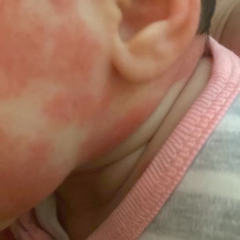 Mustela Vücut Losyonu İnanılır Gibi Değil Bebeğimin Yüzü Yandı