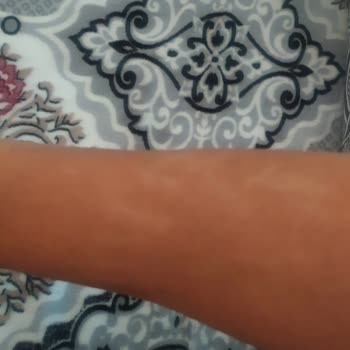 Philips Lumea Kullandıktan Sonra Kollarımda Yanık İzi Oluştu