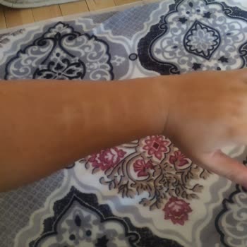 Philips Lumea Kullandıktan Sonra Kollarımda Yanık İzi Oluştu