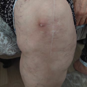 Sancaktepe Şehit Prof. Dr. İlhan Varank Eğitim Araştırma Hastanesi Hastasını Sakat Bıraktı!