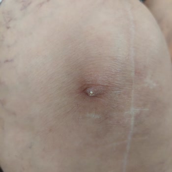 Sancaktepe Şehit Prof. Dr. İlhan Varank Eğitim Araştırma Hastanesi Hastasını Sakat Bıraktı!