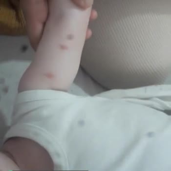 Bebelac Mama Alerji Yaptı!