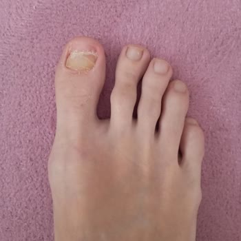 Biga Devlet Hastanesi Ortopedi Bölümündeki Tedavi Süreciyle İlgili Şikayet