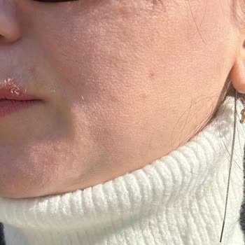 Jeuvenile Jeuvenille C Vitamini Serumu Sivilcelenme Sorunu